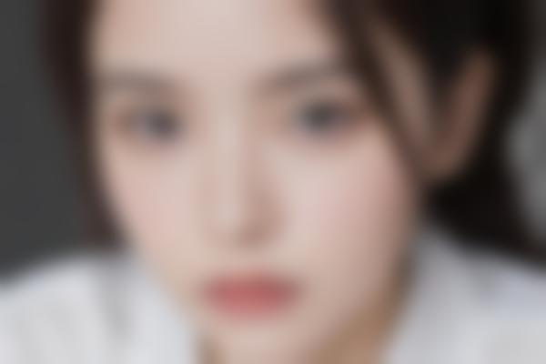 3、静萍胎记疤痕修复可靠