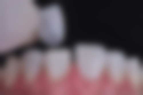 仅19.9元！深圳美莱口腔门诊部隐形矫正3D扫描，预知效果定制方案 