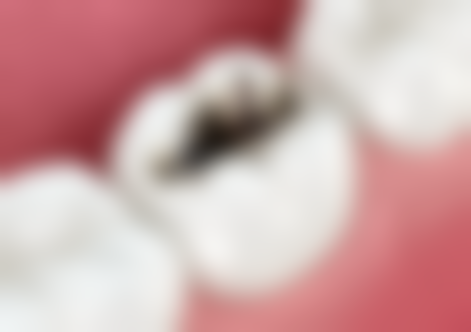 【节假日通用】瑞士EMS洗牙含喷砂项目详解