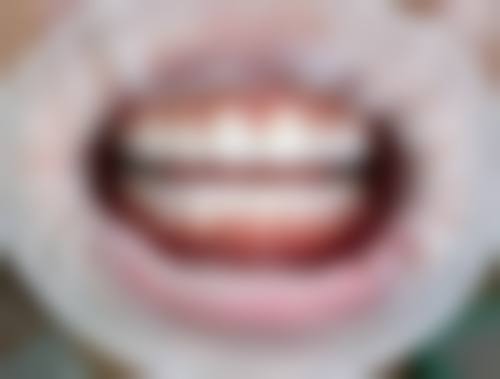 曹玉飞的服务细节与术后保护