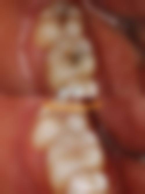 中山华伟口腔收费参考标准